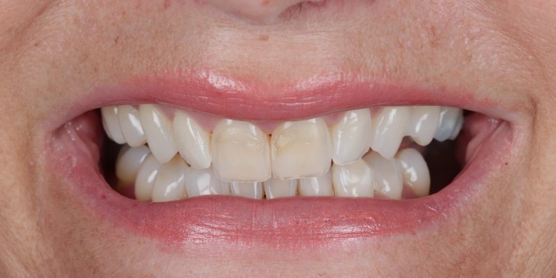 Before - Rochester Lodge Dental