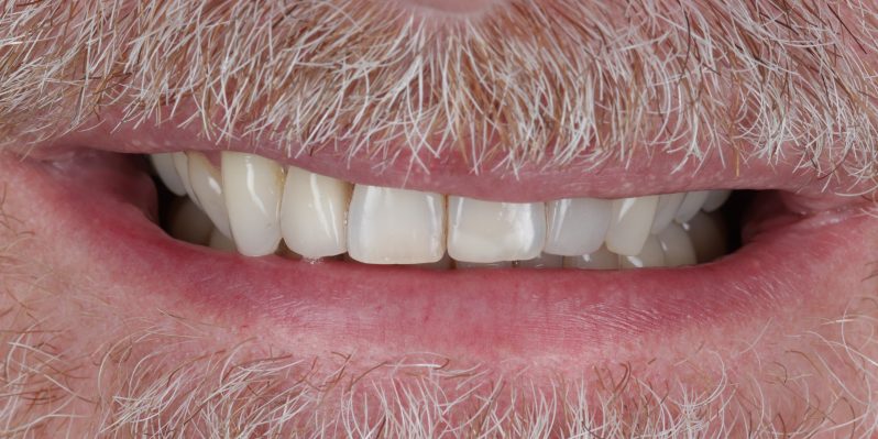 Before - Rochester Lodge Dental