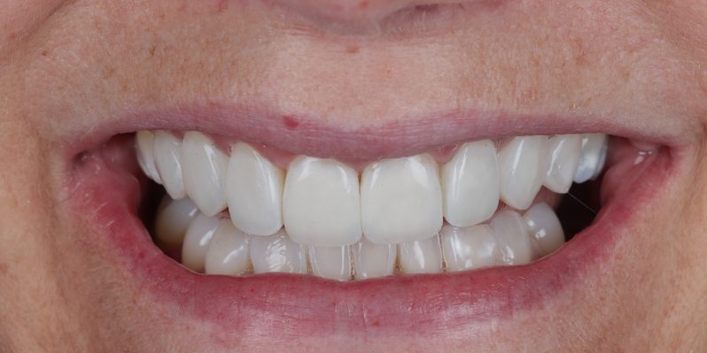 After - Rochester Lodge Dental