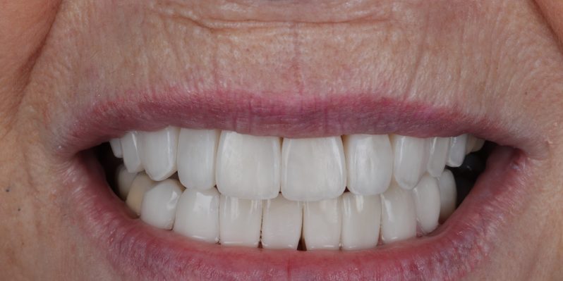 After - Rochester Lodge Dental