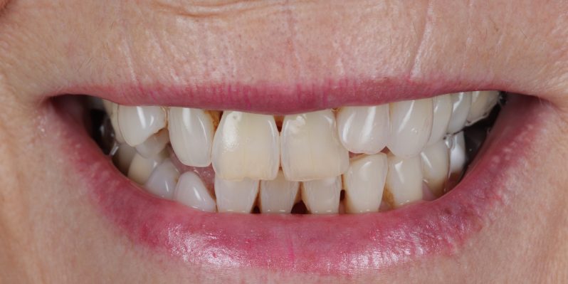 Before - Rochester Lodge Dental