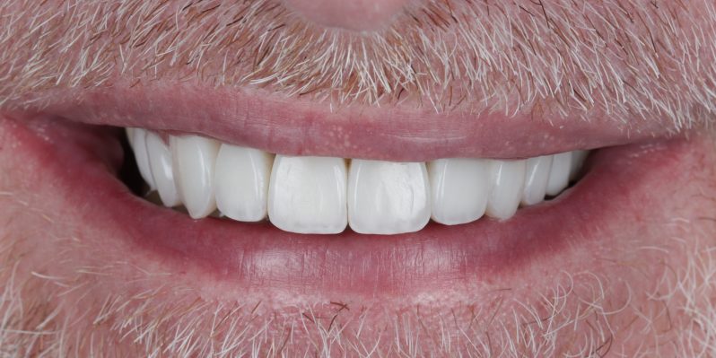 After - Rochester Lodge Dental