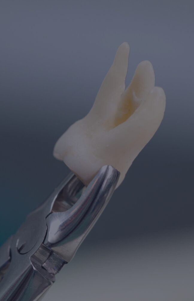 Tooth Extraction